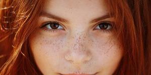 العوامل الوراثية .. أبرز  أسباب ظهور  النمش في الوجه - نايل 360